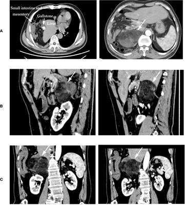 Surgical approach for complete resection of giant retroperitoneal liposarcoma with diaphragmatic hernia via ninth rib thoracotomy